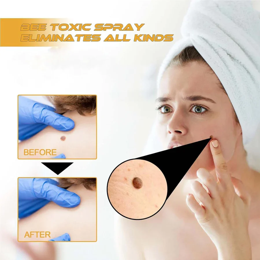 Herbal Wart & Skin Tag Remover ( 🔥 Buy 1 Get 1 FREE )