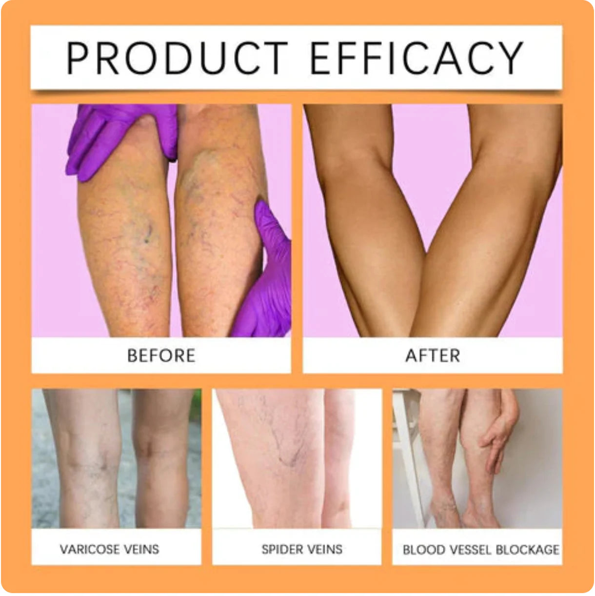 Vein Healing Varicose Veins Treatment Spray Pack of 2