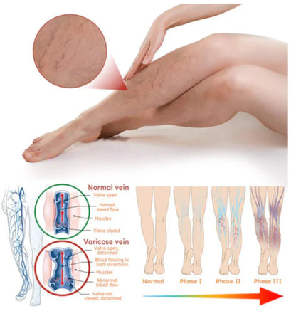 Vein Healing Varicose Veins Treatment Spray Pack of 2