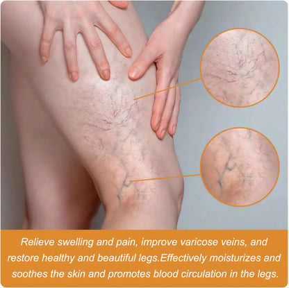 Vein Healing Varicose Veins Treatment Spray Pack of 2
